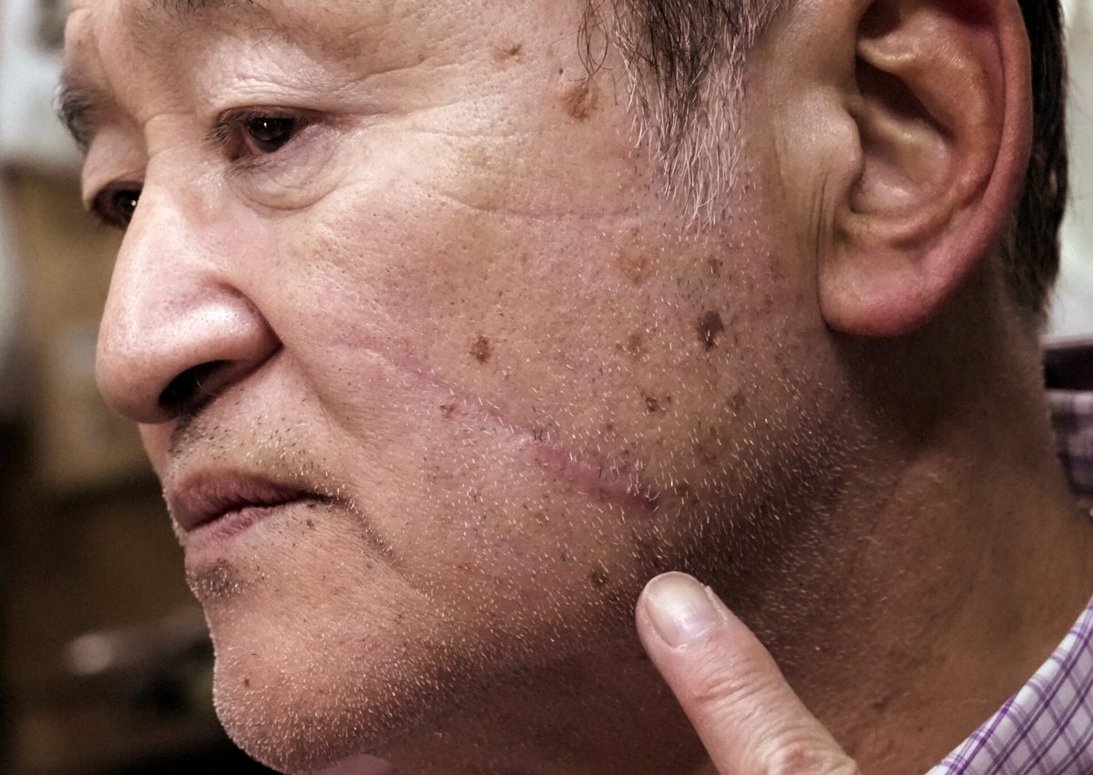 Keiji Minatoya, a bear attack survivor, points at his scar